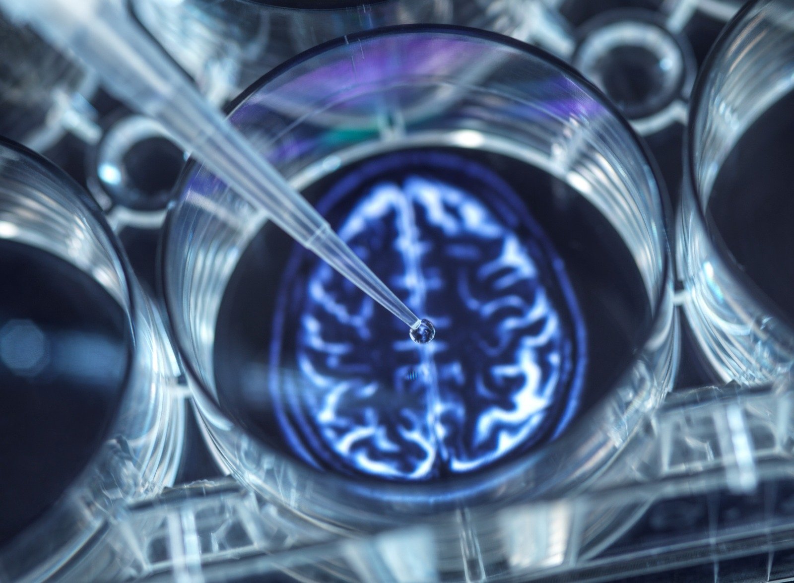 Las mujeres tienen mayor riesgo de padecer Alzheimer